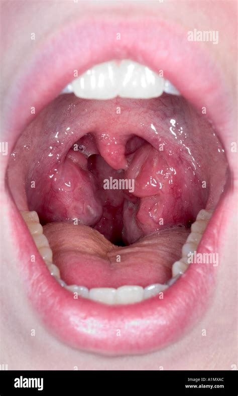 estreptococo en la garganta